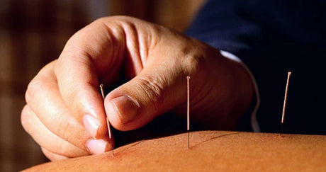 What is acupuncture?