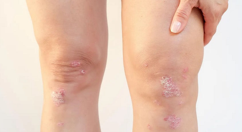 Psoriasis